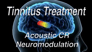 Tinnitus Treatment Using Acoustic Coordinated Reset Neuromodulation ACRN [upl. by Hasila]