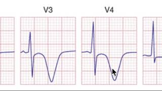 Most Important EKGs T wave inversion in Ischemia [upl. by Leroy564]