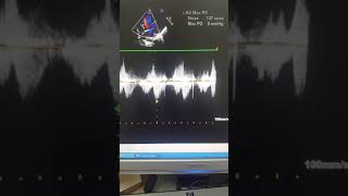 Case54 echocardiography  TOF with absent Pulmonary Valve [upl. by Tortosa]