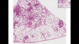 Histopathology LungBronchopneumonia [upl. by Yduj]