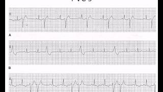 Easy EKG Premature Ventricular Contractions and Atrial Fibrillation [upl. by Hagi]