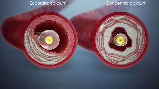 Shockwave IVL in Eccentric vs Concentric Calcified Lesions [upl. by Ecirted]