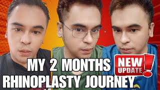 MY 2 MONTHS RHINOPLASTY JOURNEY by Doc Lacson of Kosmed From Day One to 2 Months [upl. by Enamart]