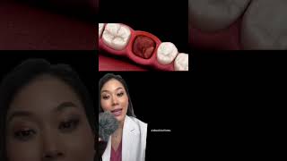 How to avoid dry socket after wisdom tooth extraction wisdomtooth wisdomteeth drysocket tooth [upl. by Thynne145]