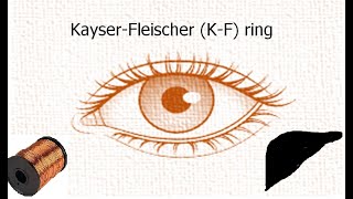 Copper metabolism  Eye Ring  Kayer Fleischer ring I Wilsons disease [upl. by Ralph]