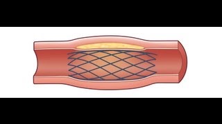 Carotid Stent Healthy Heart with Cardiologist Dr Annie Varughese [upl. by Ecnirp]