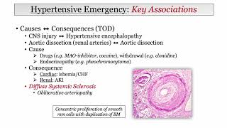 12DaysinMarch Blood Pressure III Malignant HTN for the USMLE Step One Exam [upl. by Koerner]