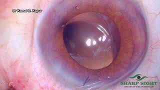 Management Of tilted amp decentered IOL in a fibrosed capsule sharp sight by Dr Kamal Kapur [upl. by Aziza764]