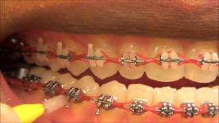 111 HOW TO USE MY INTERDENTAL TOOTHPICKS WITH BRACES ON [upl. by Mcgray]