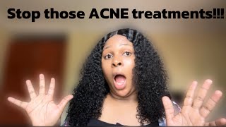 Stop those acne treatments DO THIS instead [upl. by Quickel]