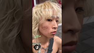 Pimples amp Pigmentation removal cream Zahira Cream pimples pigmentation shorts youtubeshorts [upl. by Lynea]