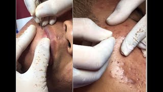 Best Pimple Popping 14 beautiful blackheads sacdepspa [upl. by Aceissej]