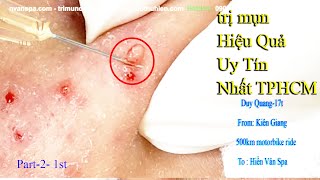 Điều Trị Mụn Viêm Mụn Bọc Mụn Ẩn Hiệu Quả tại Hiền Vân spa I Duy Quang 17t I bài 287 [upl. by Erdeid998]