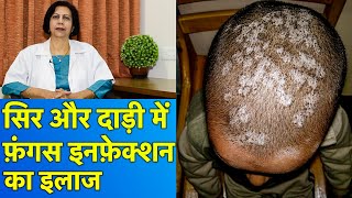 सिर और दाड़ी के फ़ंगस इनफ़ेक्शन का इलाज  Treatment of Fungal Infections In Beard amp Scalp [upl. by Fernando]