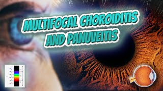 Multifocal choroiditis and panuveitis  Your EYEBALLS  EYNTK 👁️👁️💉😳💊🔊💯✅ [upl. by Faria]