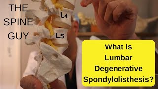 What is Lumbar Degenerative Spondylolisthesis  Part 1 [upl. by Samuella821]