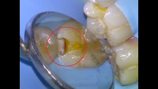 22 Dental filling for decay between teeth [upl. by Nocaed]