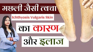 Ichthyosis VulgarisFish Skin Causes Symptoms And Treatment in Hindi  Dry Skin Cure [upl. by Henleigh]