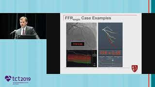 FFRangio Compared to FFR – Clinical Data and Subgroup MVD Analysis [upl. by Curran]