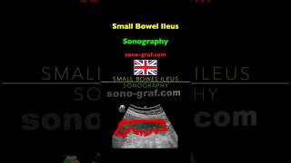 Sonography  Small Bowel Ileus [upl. by Tterrej]