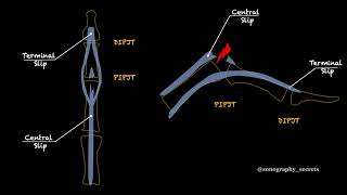 Boutonniere deformity [upl. by Arihat]