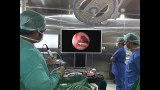 Eustachian Tube Balloon Dilation by Dr GVK Chaitanya Rao at Dr Raos ENT [upl. by Hayott355]