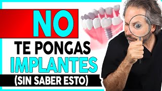 👉¿Que 𝗗𝗘𝗕𝗢 𝗦𝗔𝗕𝗘𝗥 del proceso de colocación de 𝗜𝗠𝗣𝗟𝗔𝗡𝗧𝗘𝗦 𝗗𝗘𝗡𝗧𝗔𝗟𝗘𝗦 para elegir a el DENTISTA ADECUADO [upl. by Anotal]