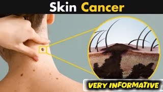 What Happen in Skin Cancer   Symptoms amp Causes and Treatment [upl. by Biamonte285]