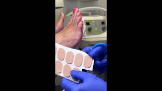 5th toe corn pad and debridement  short debridement toecornpad [upl. by Rosalba]