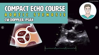 〖Echocardiography〗 Aortic stenosis  CW Doppler 5ChV amp the PSAX 🫀 [upl. by Iegres]