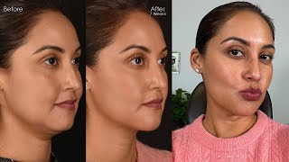 Julias Facial Slimming Results  Deep Neck Liposuction Buccal Fat Removal amp Fat Transfer to Face [upl. by Nolan165]