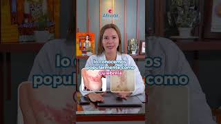 Dolor por Herpes Zoster quotCulebrillaquot [upl. by Lainey]