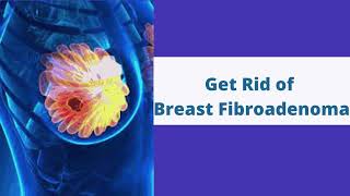 Breast Fibroadenoma Treatment Without Surgery in Hyderabad  VABB Treatment [upl. by Griffiths]