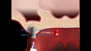 Sinus Ascensore  Sinuslift [upl. by Saint]