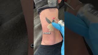 Tattoo Removal hwclinicbrugge [upl. by Mcmath]