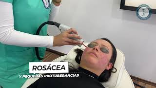 😳¿Quieres Conocer un Tratamiento Para La Rosácea El Láser Vbeam Candela Te Ayudará✅😎 Racderma [upl. by Kesia542]