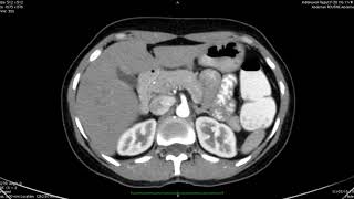 TMT Pancreatic Imaging by Dr Ankur Shah Protocols [upl. by Haeluj]