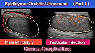 Acute Epididymo Orchitis Ultrasound  Male Infertility  Causes  Complications [upl. by Bobina525]