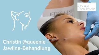 Jawline  Behandlung  Kinnlinie unterspritzen [upl. by Yromas]