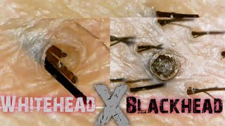 Blackhead and Whitehead on the ScalpSatisfying ExtractionClose Up [upl. by Verge422]