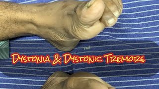 Dystonia Dystonic Tremors Extrapyramidal manifestations STRIATAL TOE [upl. by Stag]