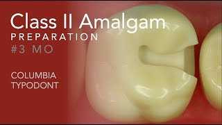 Class II Amalgam Preparation 3 MO [upl. by Ihn]