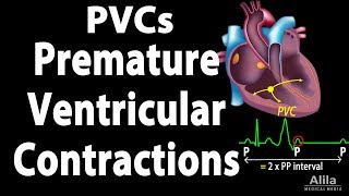 Premature Ventricular Contractions PVCs Animation [upl. by Neall]