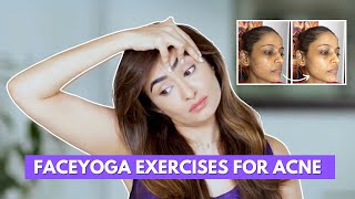 Faceyoga exercises for acne by Vibhuti Arora [upl. by Ricarda]