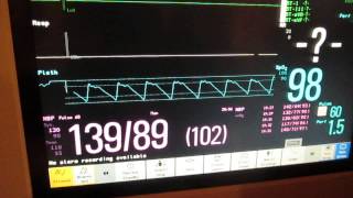 NIBP measure [upl. by Etra595]