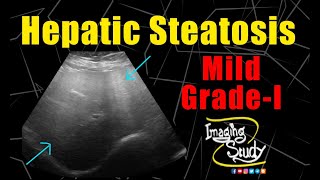 Mild Hepatic Steatosis  GradeI Fatty Liver  Ultrasound  Case 230 [upl. by Rolyab]