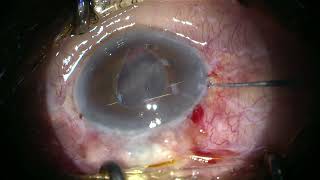 SinglePass 4Throw suture for iris fixation of subluxated IOL [upl. by Banyaz]