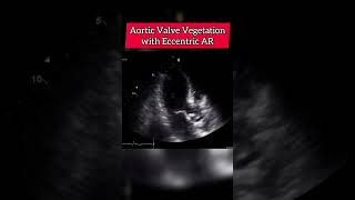 Aortic Valve Vegetation with eccentric AR echocardiography [upl. by Aromat174]