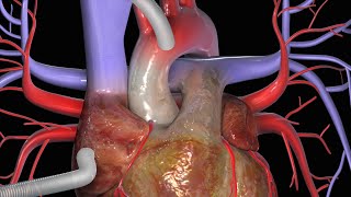 Cirurgia de Revascularização do Miocárdio CRM [upl. by Eldwin]