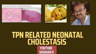 TPN related cholestasis neonatalcholestasis preterm TPN [upl. by Georgina87]